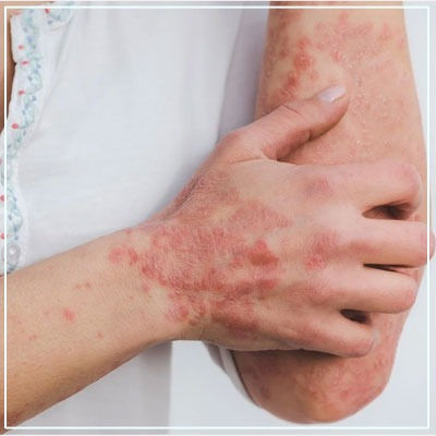 Psoriasis Treatment in Mumbai