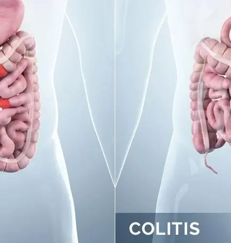 Inflammatory Bowel Disease Treatment Mumbai: Comprehensive Care with Dr. Chintamani Godbole