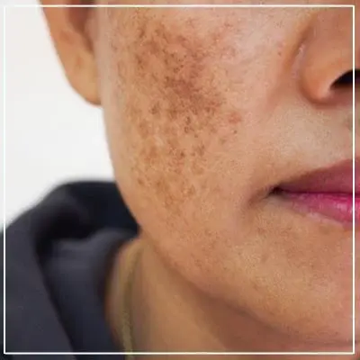 melasma treatment mumbai