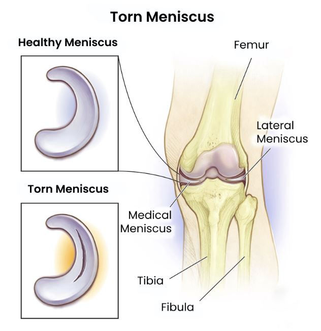 Meniscus Repair Surgery in Bangalore