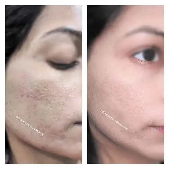 Acne scar treatment