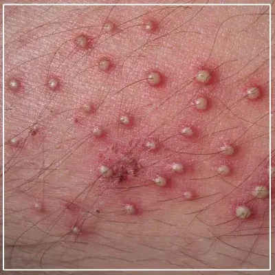 Folliculitis Treatment in Mumbai: Expert Skin Care with Dr. Deepam Shah