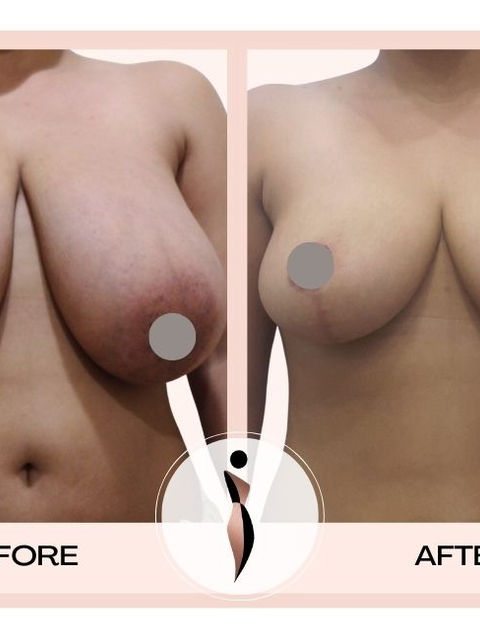 Breast Implant Doctor in Mumbai: Breast Augmentation by Dr. Amiti Shah