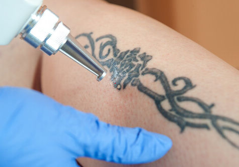 Laser Tattoo Removal in Mumbai: Interview with Dr Niketa Sonavane