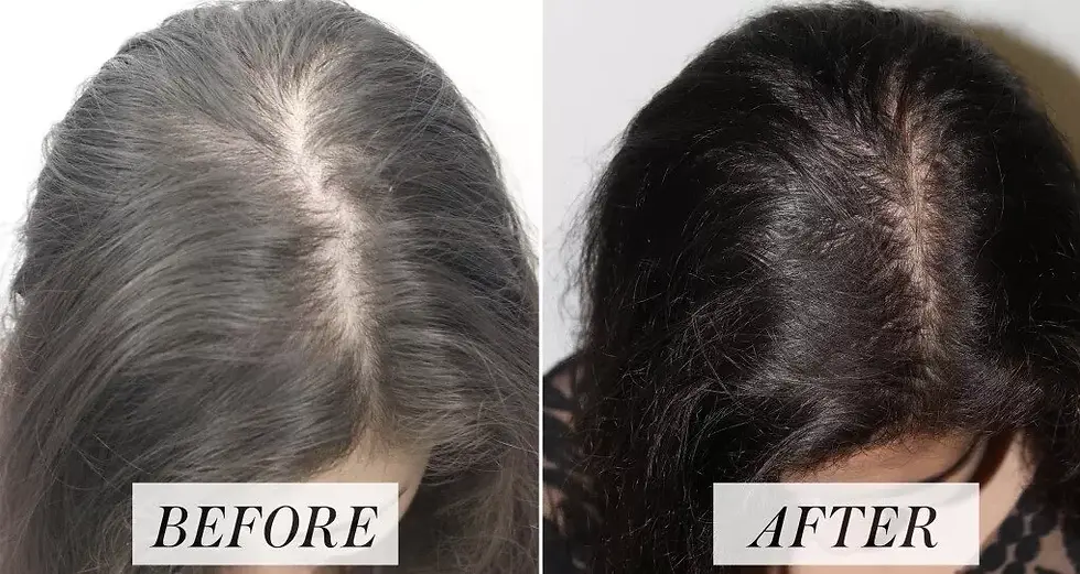 hair loss treatment in mumbai