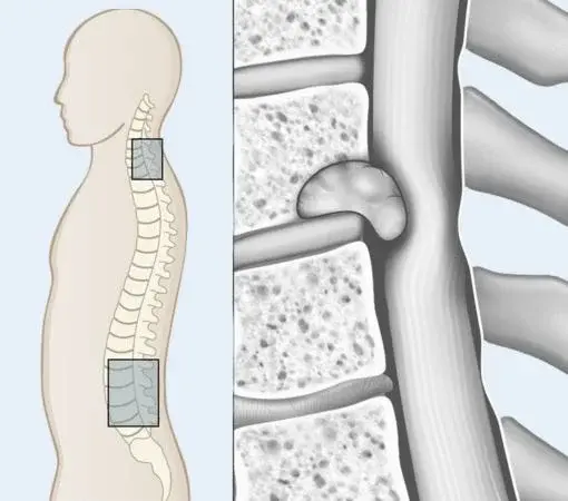 Spinal Cord Tumor Treatment in Mumbai – Advanced Spine Care at Synapse Spine