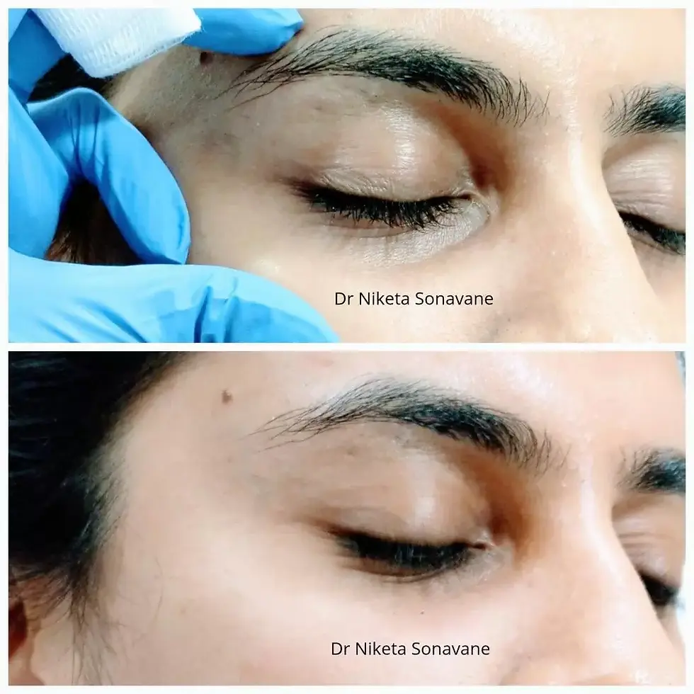 dermal fillers for under eyes