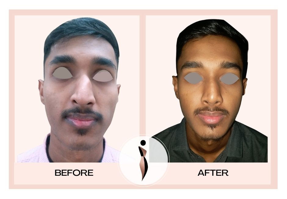 Best rhinoplasty surgeon in mumbai