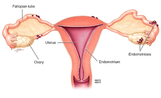 Endometriosis Specialist in Andheri West