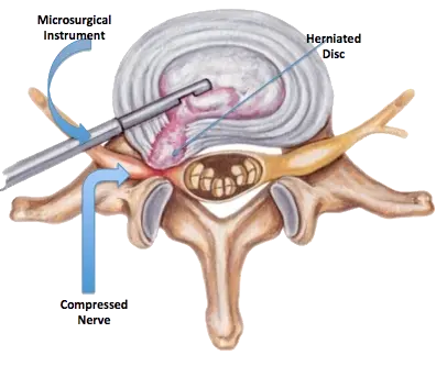 Microdiscectomy surgery in Mumbai