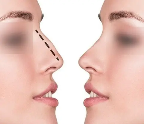 A Medical Journalist’s Perspective on Septoplasty Surgery in Mumbai