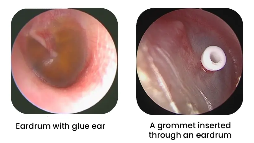 Grommet Insertion in Mumbai