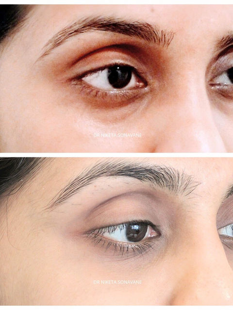 Dark Circle Treatment in Mumbai with Dr. Niketa Sonavane