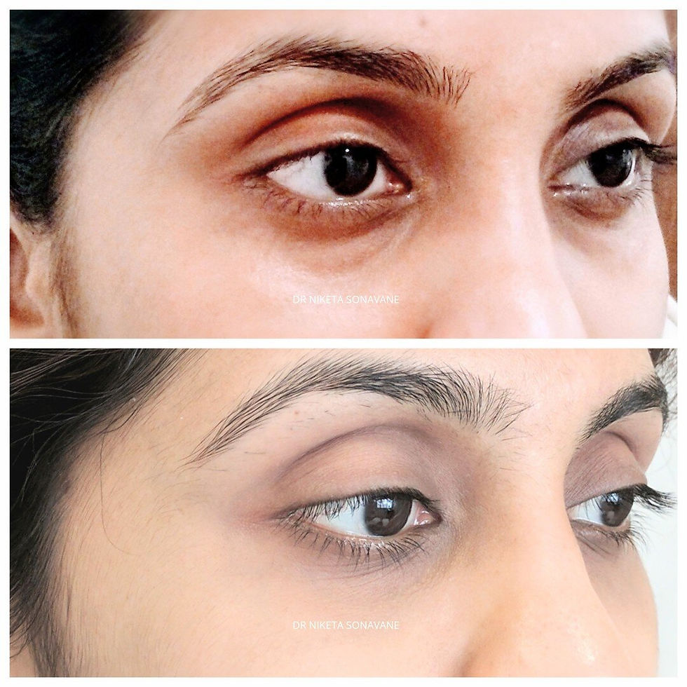 Dark Circle Treatment in Mumbai with Dr. Niketa Sonavane