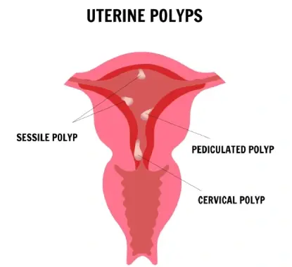 Hysteroscopic Polypectomy in Mumbai | Expert Insights