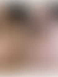 A Clinical Look at Hyperpigmentation Care in Mumbai