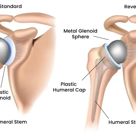 When the Shoulder No Longer Lifts: A Medical Journalist’s Visit to Opera Bone and Joint Clinic