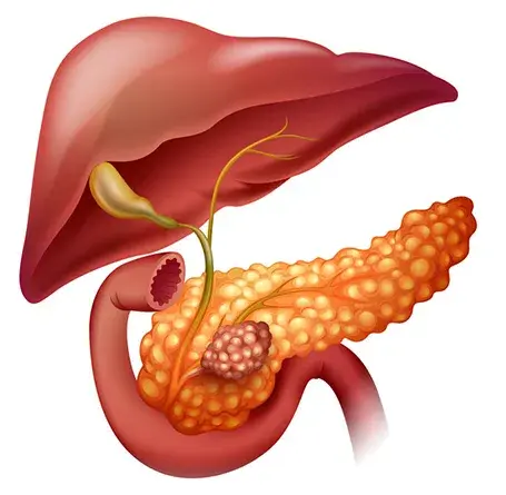 Pancreatic Cancer Treatment: Expert Surgical Care with Dr. Ganesh Nagarajan