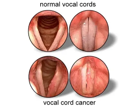 Reporting from the Clinic: Vocal Cord Cancer Treatment in Mumbai Through a Medical Lens