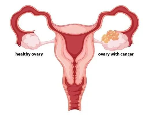 Ovarian Cancer Treatment in Mumbai