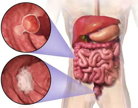 My Conversation with Dr. Chintamani Godbole on Modern Rectal Cancer Care
