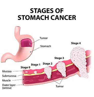 Stomach Cancer Surgery