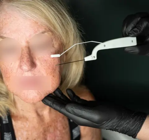 AccuTite Treatment in Mumbai | Dr Devayani Barve