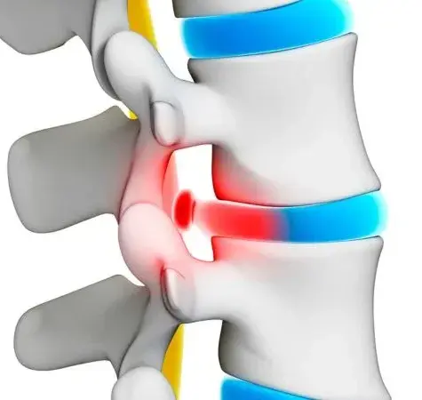 Best Doctor for Slip Disc in Mumbai: Advanced Spine Care at Synapse Spine