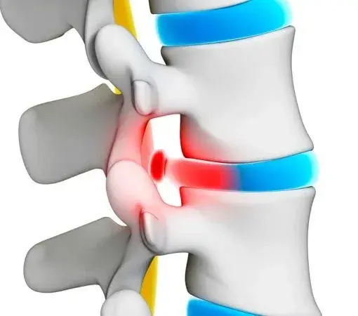 Best Doctor for Slip Disc in Mumbai: Advanced Spine Care at Synapse Spine