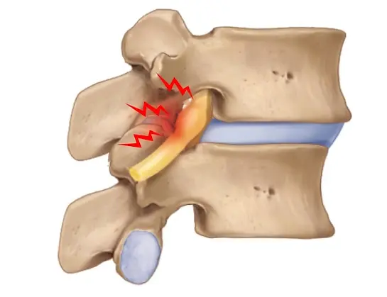 Doctors For Spondylitis Treatment In Mumbai