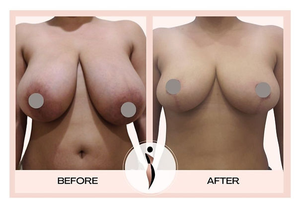 Breast Reduction Mumbai