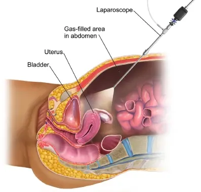 Dr Maitreyee Parulekar – Laparoscopic Hysterectomy in Mumbai Expert