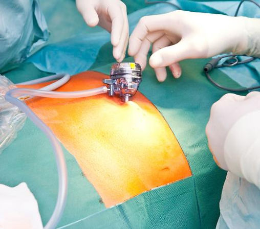 Minimally Invasive Spine Surgery in Mumbai