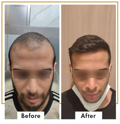High-Density Hair Transplant in Mumbai by Dr. Deepam Shah