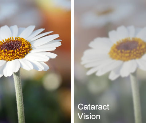 Cataract Surgery Cost Mumbai | Dr Seema Behl Guide