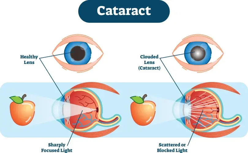 cataract specialist in andheri