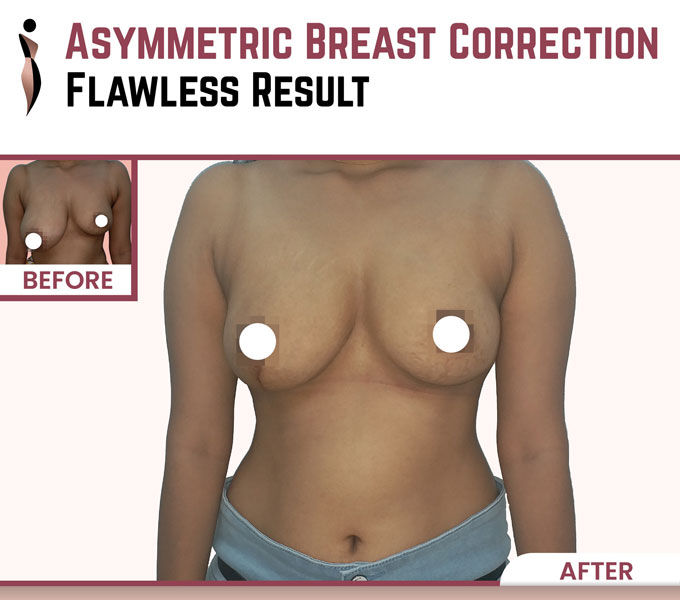 Inside the Clinic: A Medical Journalist’s Perspective on Breast Asymmetry Correction in Mumbai