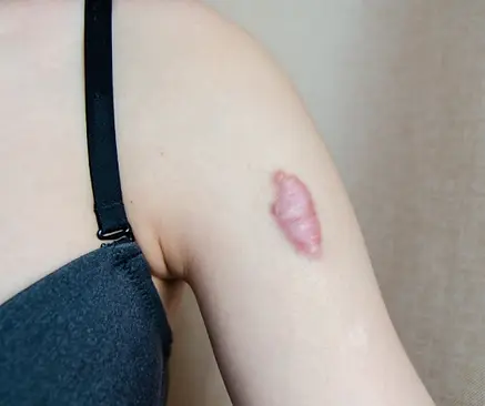 Keloid Treatment in Mumbai