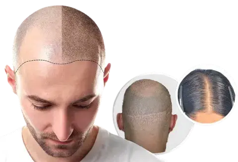 Decoding Hair Transplant Cost In Mumbai