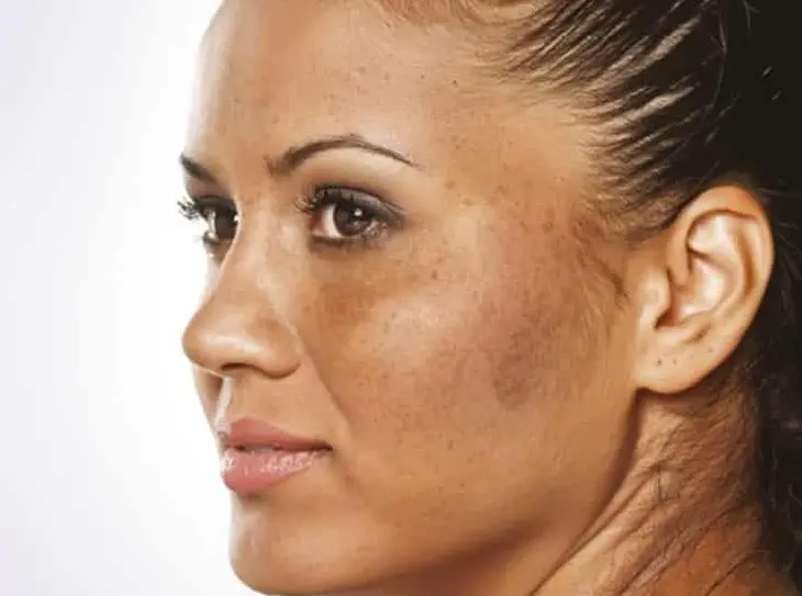 lip pigmentation treatment