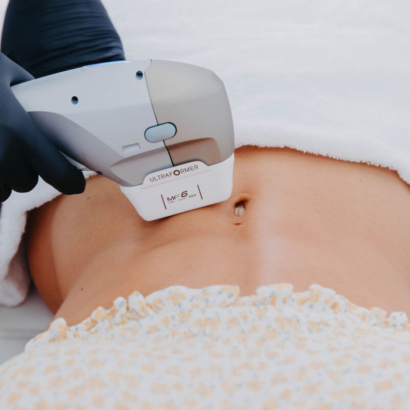 Ultraformer III Abdômen Completo