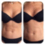Radiofrecuencia-abdomen.jpeg