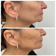 Before & after jawline filler treatment