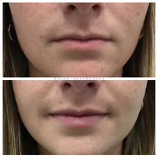 Lip filler before & after: fuller, enhanced lips