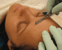 Dermaplaning