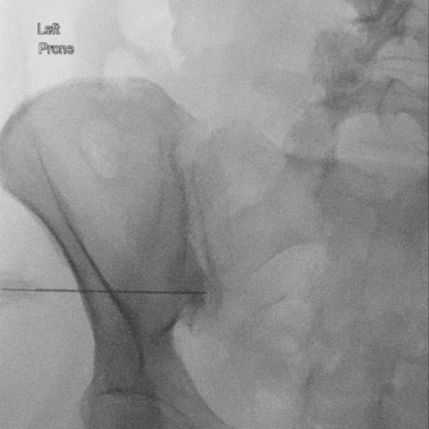 Understanding Sacroiliac Joint Dysfunction (SIJD)