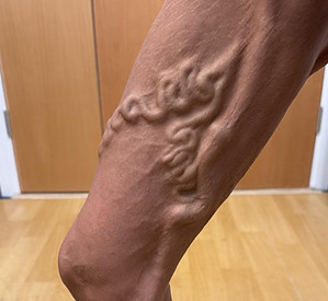 varicose veins1.jpg