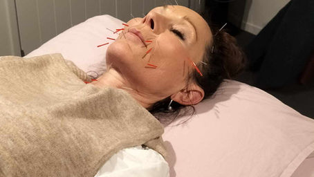 The Science Behind Cosmetic Acupuncture