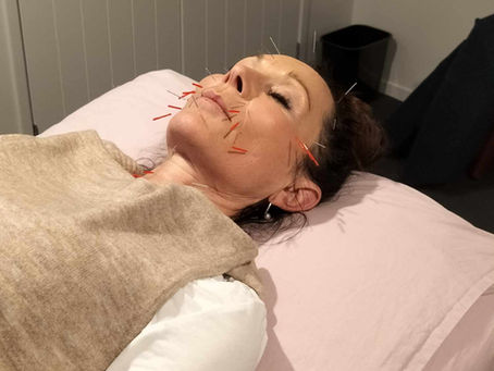 The Science Behind Cosmetic Acupuncture