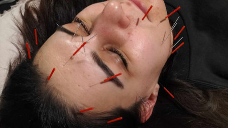 Revitalize Your Skin with Cosmetic Acupuncture